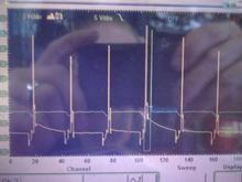 Same as above except this was taken after I replaced my coil. notice how the injector waveform has been cleaned up. this is two good waveforms. I feel the difference in the performance of the engine. feels to have increased the strength in horsepower. no more laziness