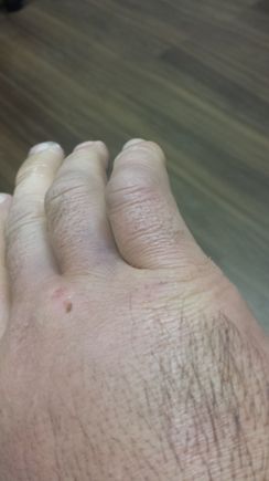 Broken right hand