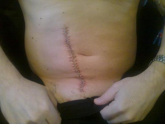 35 staples - Right Rectus Abdominus harvested for Flap &amp; Graft proceedure - January 2010