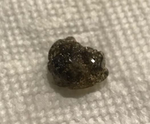 Seriously?  what the he11 is this???  there were two.  This one about the size of a peanut, other about 1/2 that size
