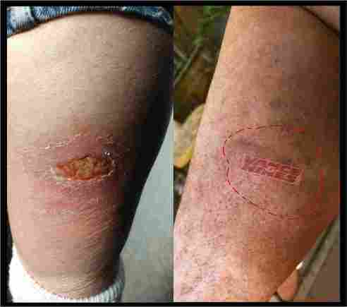 Comparing burn marks