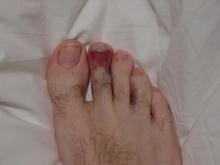 Gross Toe2.JPG