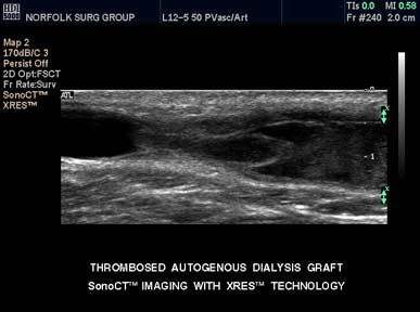 venous-stenosis1.jpg